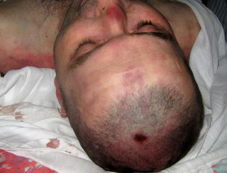 Следы побоев на теле Тархана Картоева. Фото предоставлено родственниками 