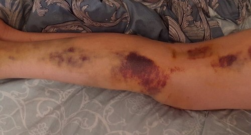 Травмированная во время инцидент нога Плиевой. Фото предоставлено "Кавказскому узлу" Саломеей Плиевой.